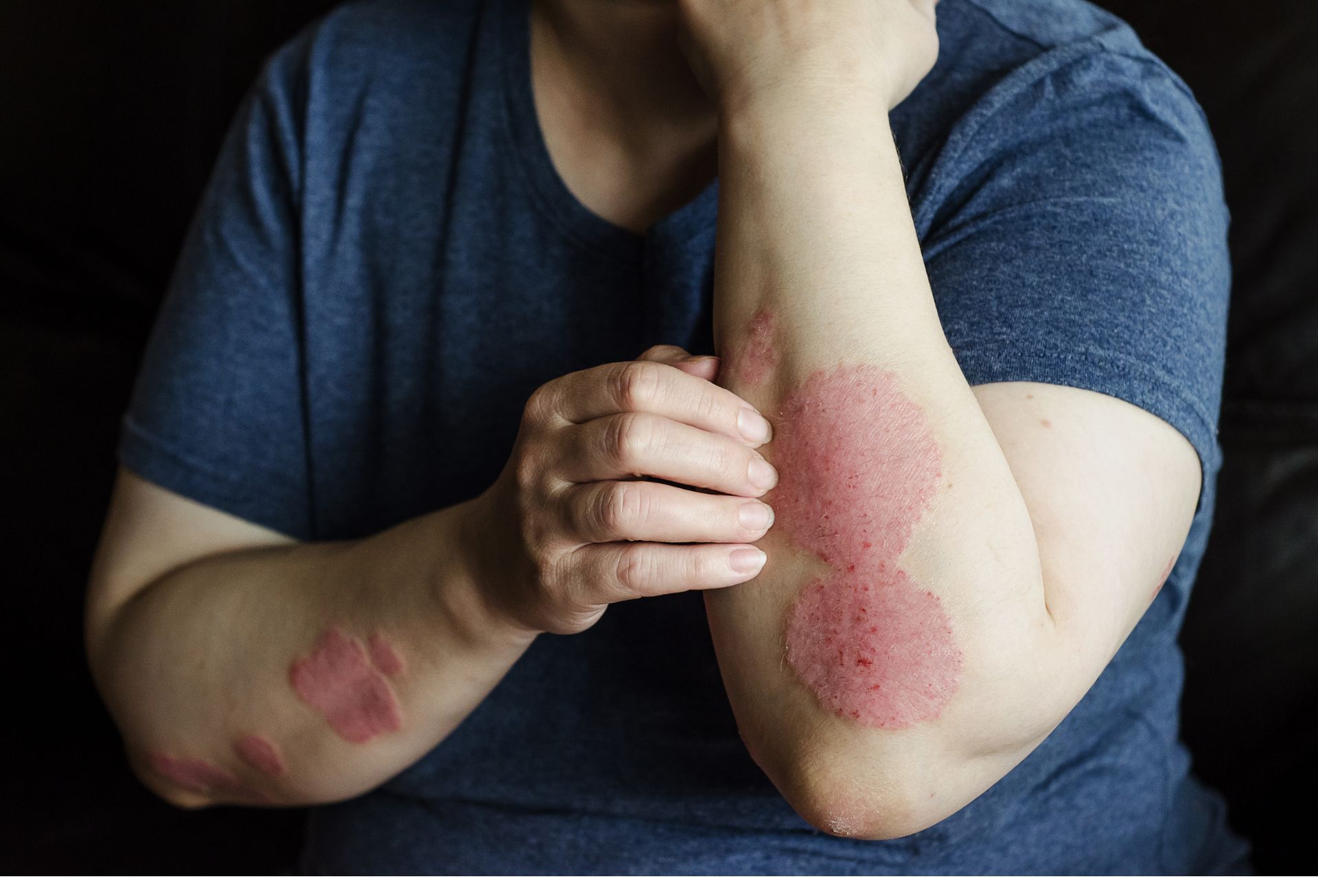 psoriasis treatment dubai