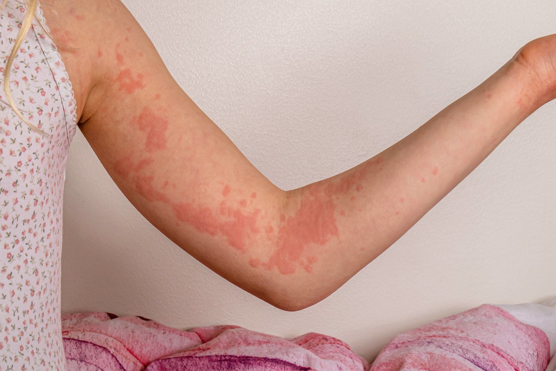 Ayurvedic Treatment for Urticaria (Hives) in Dubai